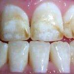 Tratamento de manchas brancas ou amareladas nos dentes com Infiltração resinosa: uma abordagem indolor, minimamente invasiva e conservadora.