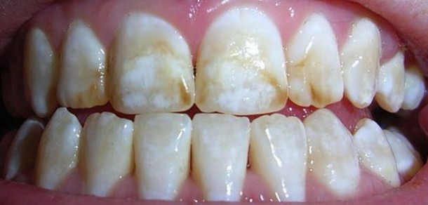 dentes-manchados-pasta-de-dente-610x292-1