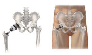 artrose de quadril causa dor e incapacidade, pois desgasta a articulação do quadril
