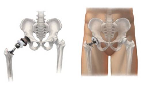 artrose de quadril causa dor e incapacidade, pois desgasta a articulação do quadril