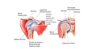 Anatomia do ombro mostrando a causa da tendinite. ë um impacto do osso do braço(úmero), contra o acromio, compriindo o tendão do supraespinal.