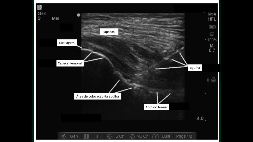 anatomia de ultrassom do quadril para uma punção guiada