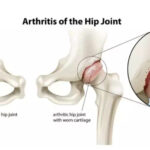 Osteoartrose de Quadril: