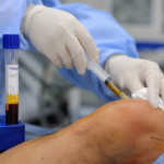 PRP (Plasma Rico em Plaquetas) na Ortopedia e Medicina Esportiva: o que é, como funciona e quando é indicado